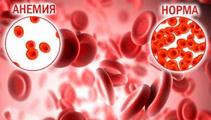 Симптомы низкого гемоглобина в крови