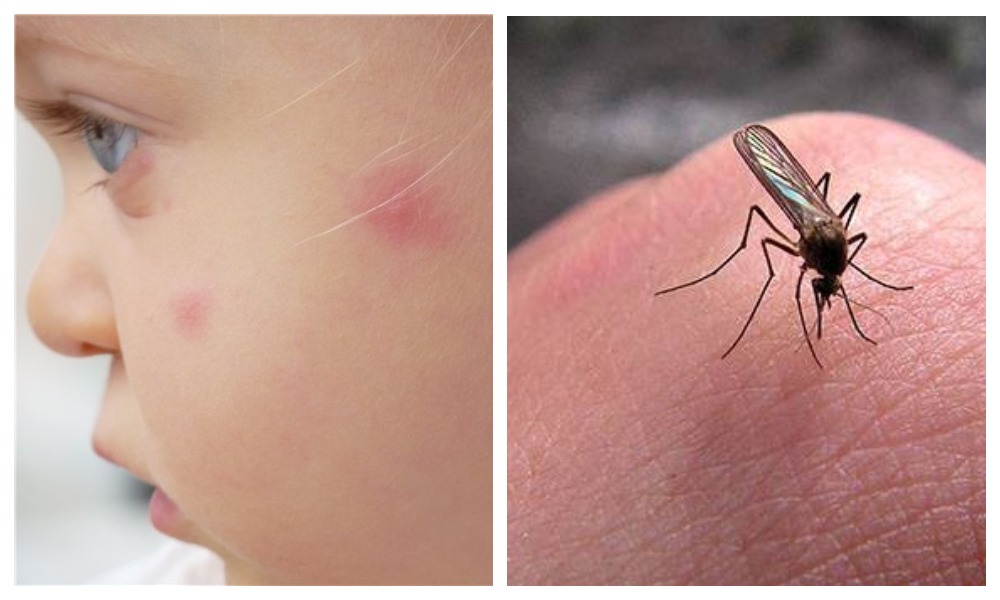 Что делать, если комариный укус зудит и чешется